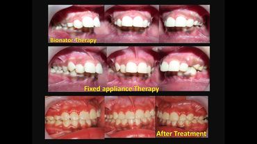 ORTHODONTIC TREATMENT OF A CLASS II MALOCCLUSION at Align Orthodontics Sector 57, Gurgaon