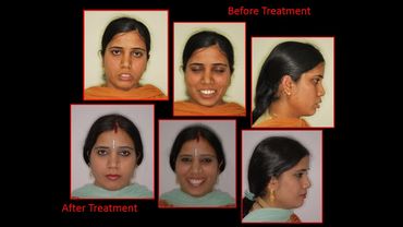 Smile Makeover, Pre bridal smile correction, Best orthodontic treatment Gurgaon Jalandhar, Braces