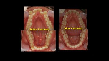 Before and after Orthodontic treatment with Braces,at Align orthodontics