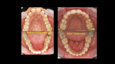 Fixed retention, low maintenance teeth, smile correction, braces iat Align Orthodontics