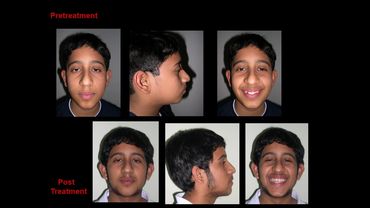 Dr. Anil Sharma Orthodontic cases, Best Orthodontist Jalandhar, Best Orthodontist Gurgaon, Braces