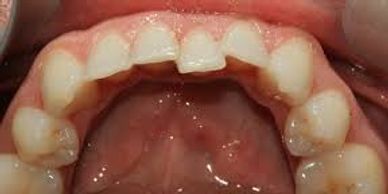 Little slip in alignment of teeth is possible if retainers aren't worn after Orthodontic treatment