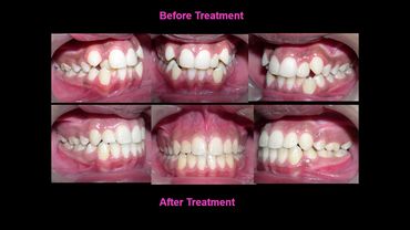 Orthodontic treatment for narrow arches by Prof Dr Anil Sharma at Align Orthodontics