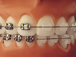 Metal braces,
Metal self-ligating braces, 
Ceramic braces,
Clear braces,
Aligner braces