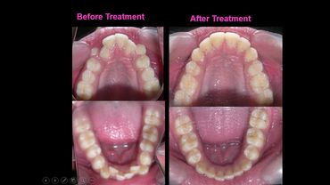 Straight teeth, Curves smile, Best Orthodontic treatment in Gurgaon and Jalandhar, Dr. Anil Sharma