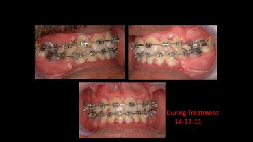 Before and after, ORTHODONTIC TREATMENT FOR CROWDED TEETH, by Prof Dr Anil Sharma