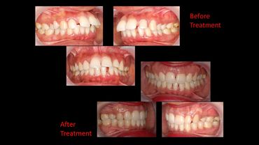 ADULT ORTHODONTICS by Prof Dr Anil Sharma