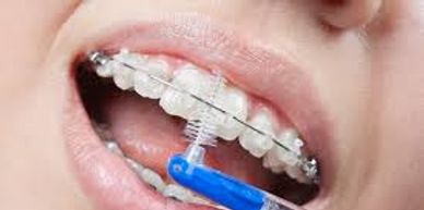 Interdental brushing is a must during orthodontic treatment to avoid cavities