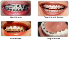 Types of braces for orthodontic treatment. Let your orthodontist decide what braces are best for you