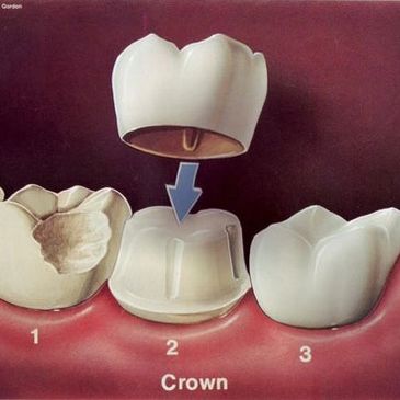 A picture example of a crown at Jonathan Loughlin Dental.