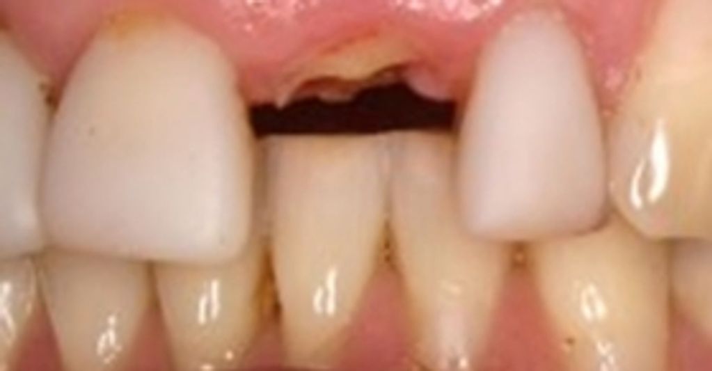 A photo of a front tooth broken off at gum level.