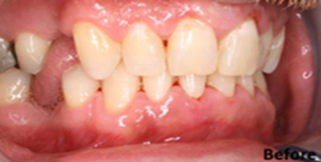 A photo of missing teeth prior to being replaced with dental implants.