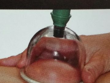 Hand holding a glass cup for cupping therapy on skin.
