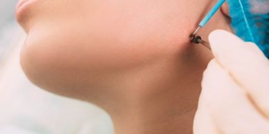 Remoção de sinal na face por eletrocauterização