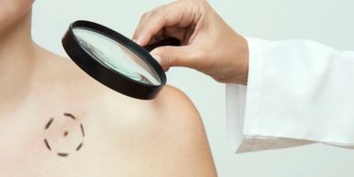 Análise de pinta ou sinal em paciente através de lupa por médico dermatologista