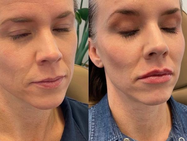 Before and after of cheek and lip filler