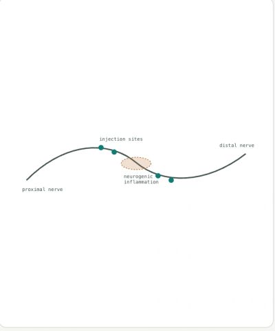 How perineural injection therapy (PIT) works: small dextrose injections placed along a nerve above a