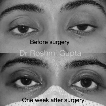 Ptosis droopy eyelid surgery, before and after