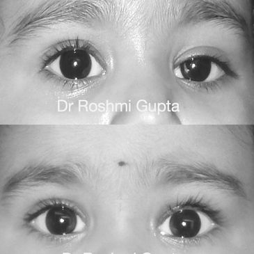 Ptosis surgery in child, droopy eyelid surgery in child