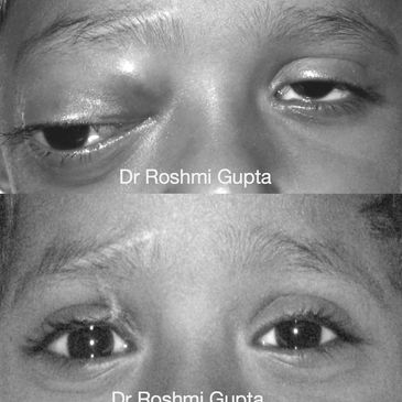 Proptosis bulging eye , before and after treatment