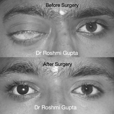 Disfigured blind eye treated with surgery and prosthesis