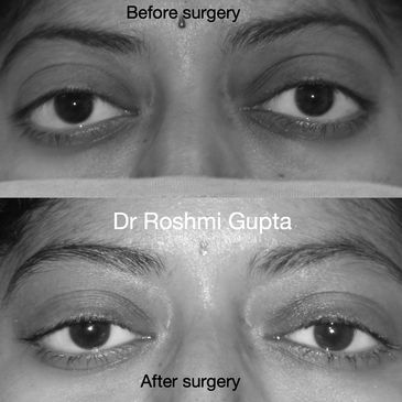 orbital decompression for thyroid eye disease, before and after surgery