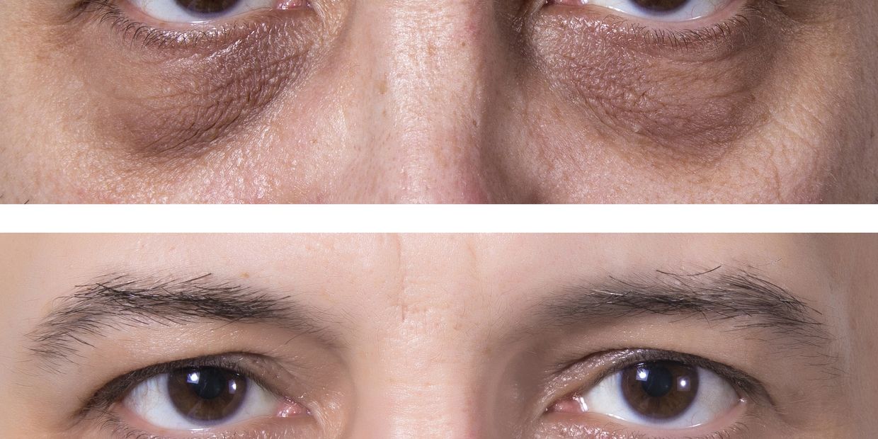 treatment under-eye dark circles little rock, treatment under-eye hollows little rock Arkansas, under-eyes hollows treatment