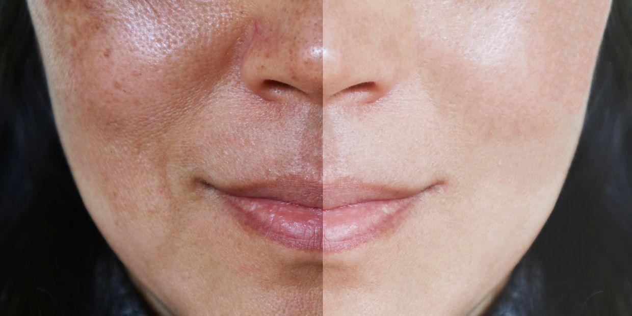 Melasma treatment little rock, hyperpigmentation treatment little rock,
melasma therapy Arkansas
