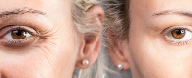 Plasma pen little rock, plasma pen near me, plasma fibroblast skin tightening little rock arkansas