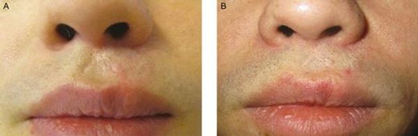 Fat Transfer Little Rock Arkansas, Fat Injection near me, Fat Stem Cells for scar improvement, Nano fat treatment Little Rock Arkansas