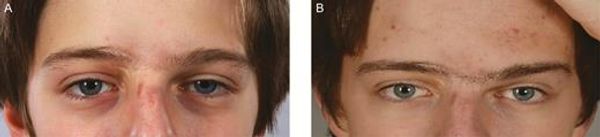 Nano fat injection for nose scar and undereye depression circles Little Rock Arkansas, Scar treatment with fat injection near me