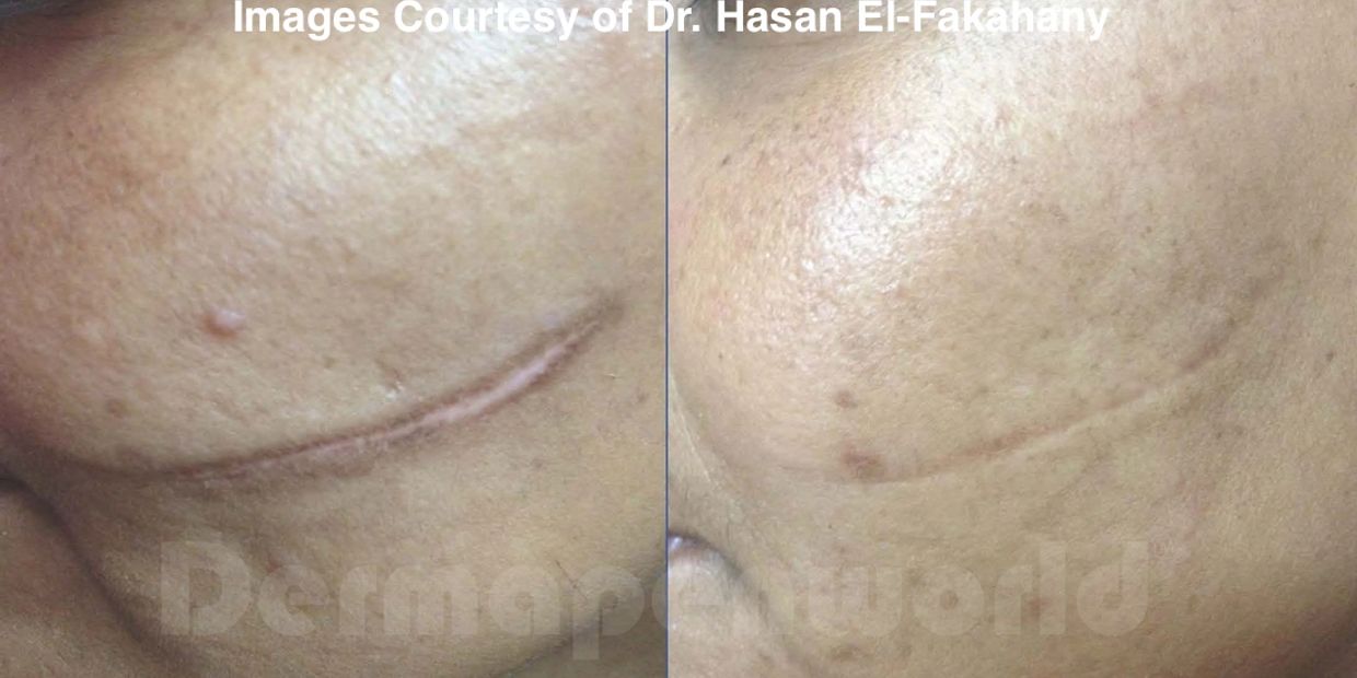 dermapen little rock, dermapen microneedling near me, microneedling for scar near me little rock