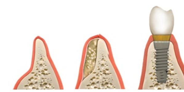 Dental Bonde graft procedure