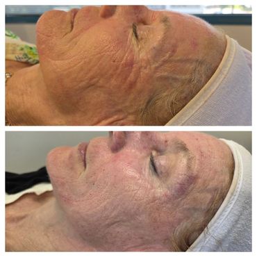 Side-by-side comparison of facial skin before and after treatment showing reduced wrinkles.