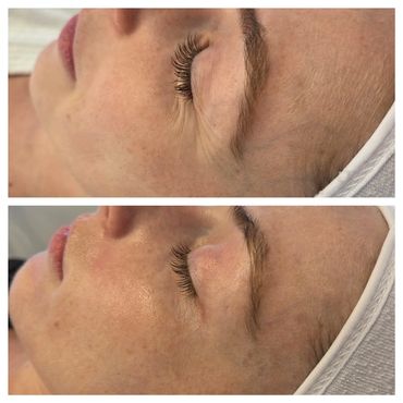 Side-by-side close-up of a woman's face before and after skincare treatment.