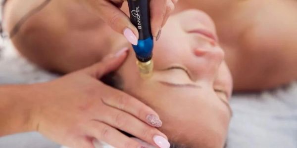 Microneedling with hyaluronic acid at Solo Esthetics And Skin Spa, Sterling VA