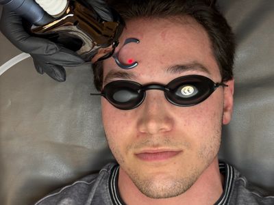 CO2 Laser Franklin TN