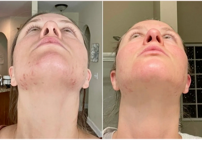 Acne treatment before and after at Tru U Esthetix in Franklin TN showing clearer skin.