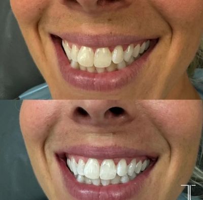 Before and after teeth whitening results at Tru U Esthetix in Franklin, TN