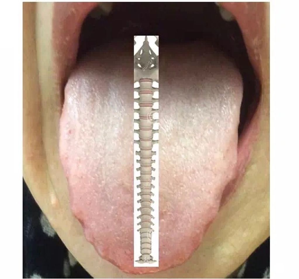 Spine on the tongue 