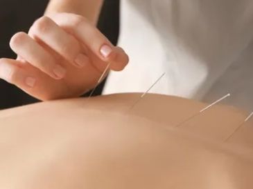 Body acupuncture
