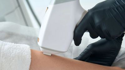 Close-up of laser hair removal treatment on a leg.