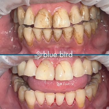 A patient's before and after cleaning