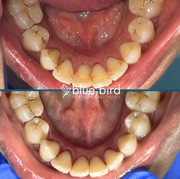 A patient's before and after cleaning