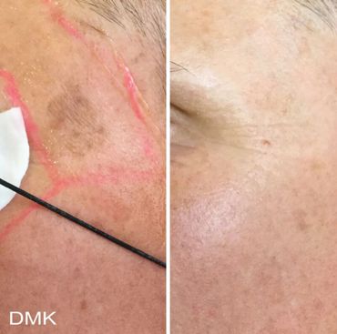 DMK Sun Damage Before and After