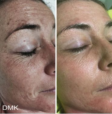 DMK Before and After