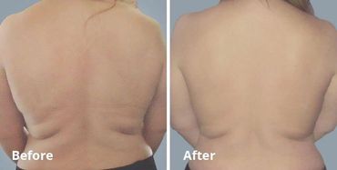 Skin tightening