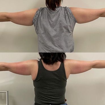 RF arm fat reduction and tightening.