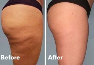 Body contouring, Cavitation, RF skin tightening, Cellulite reduction.