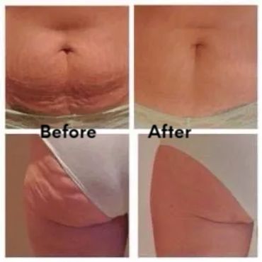 RF skin tightening and cellulite reduction
